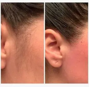 Mejillas y Patillas